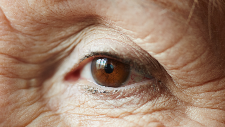 Oclusão arterial retiniana