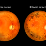 RETINOSE PIGMENTAR
