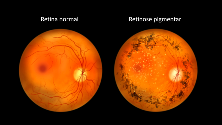 RETINOSE PIGMENTAR