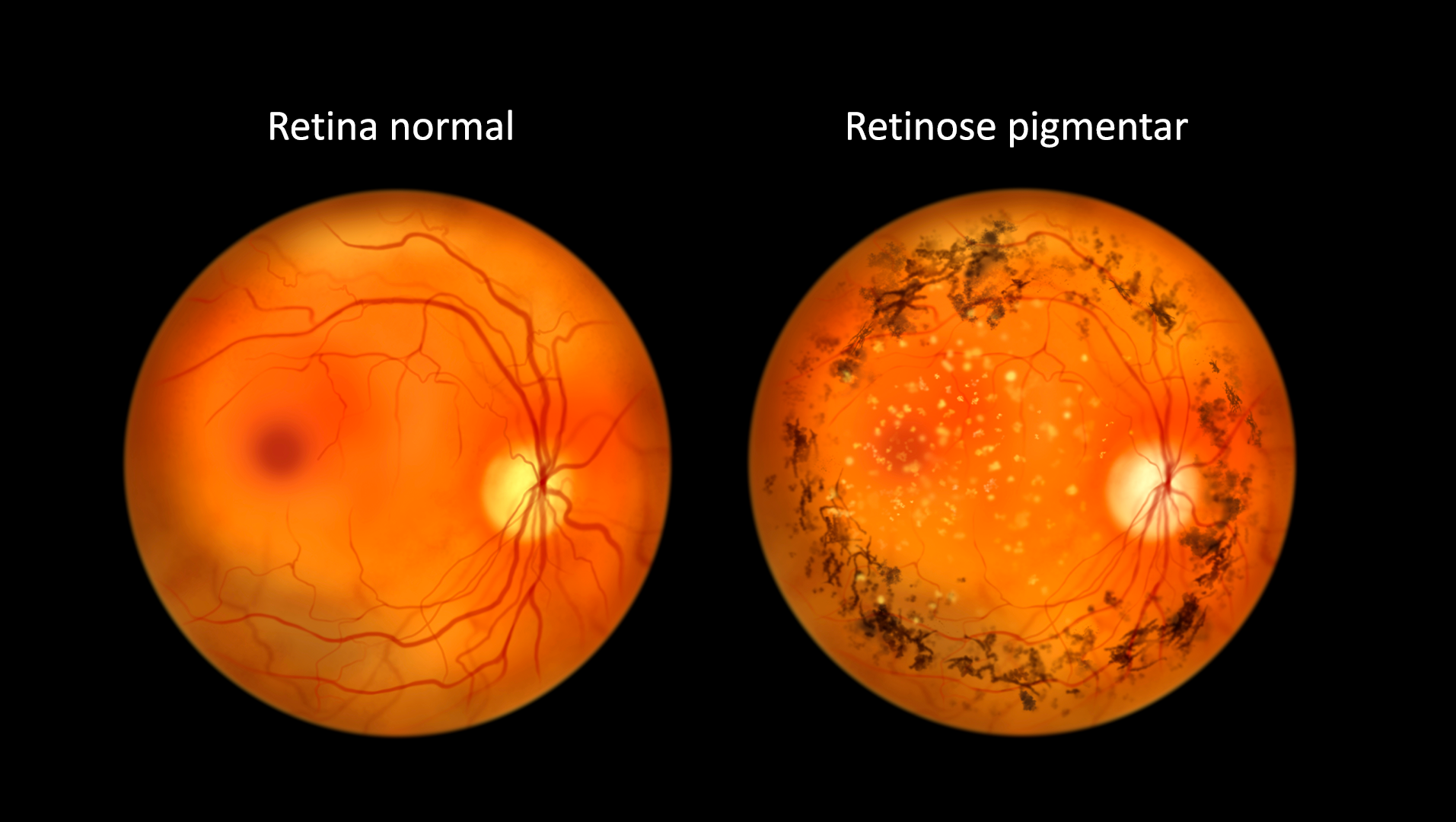 RETINOSE PIGMENTAR